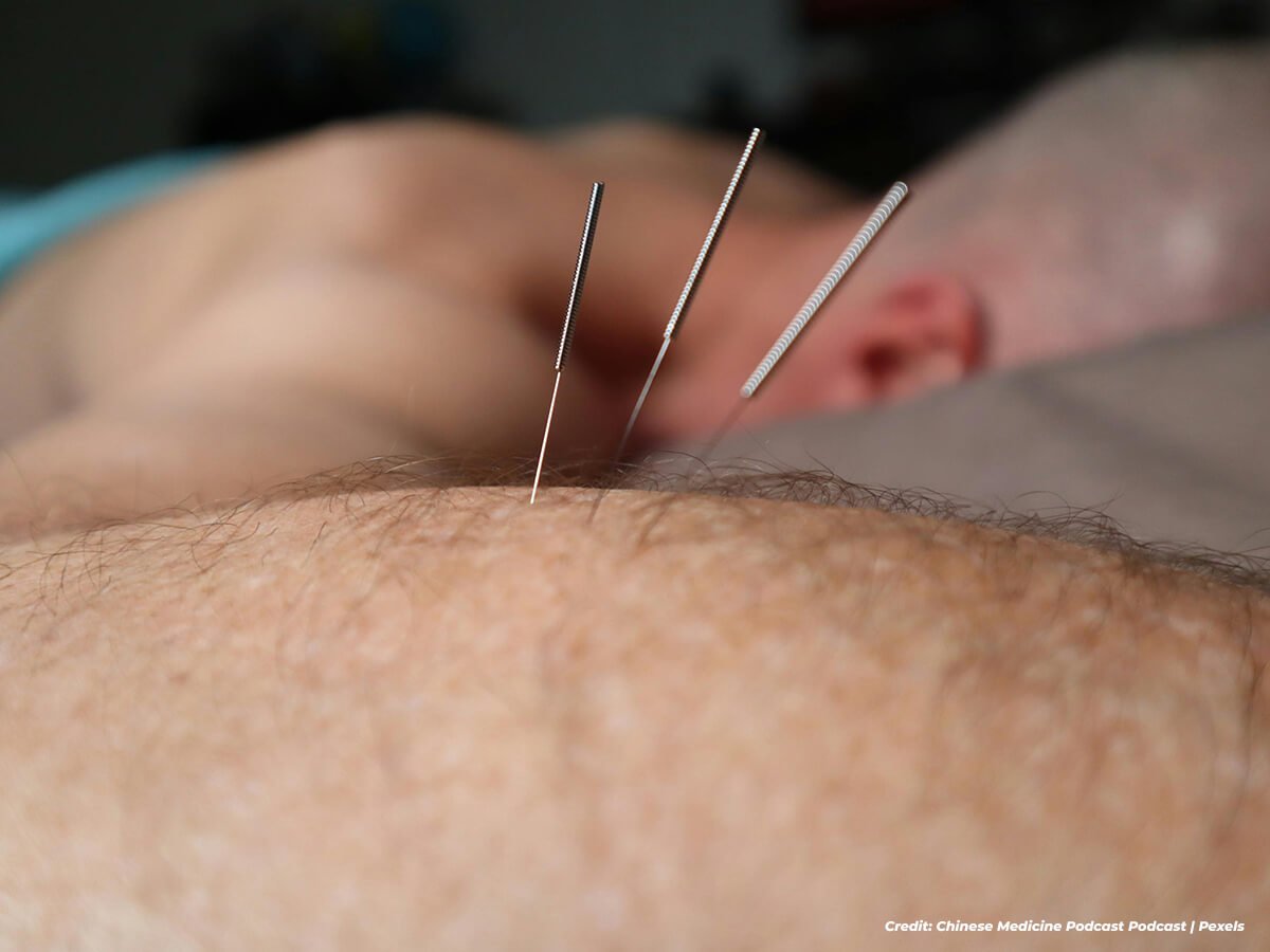 Recovering from a Sports Injury? How Acupuncture Can Speed Up Your Healing Process
