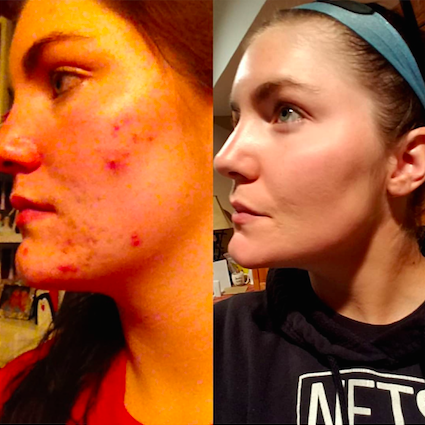 Alexandria is amazing! I honestly can’t explain how happy I am and how she’s helped my skin so much! My skincare routine is now legit from all of Alexandria’s suggestions.” -Melissa