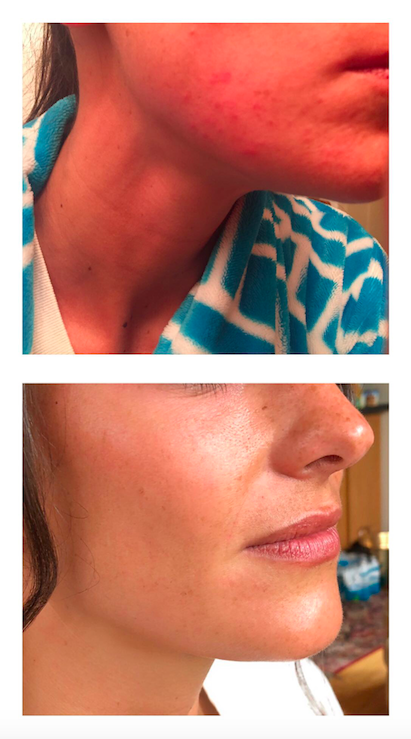 Thank you Alex so much, my skin is looking much better thanks to your recommendations! Not only did your advice help my skin before my wedding day but it’s a skincare routine I’ll use always! Even my dermatologist was impressed! -Alison