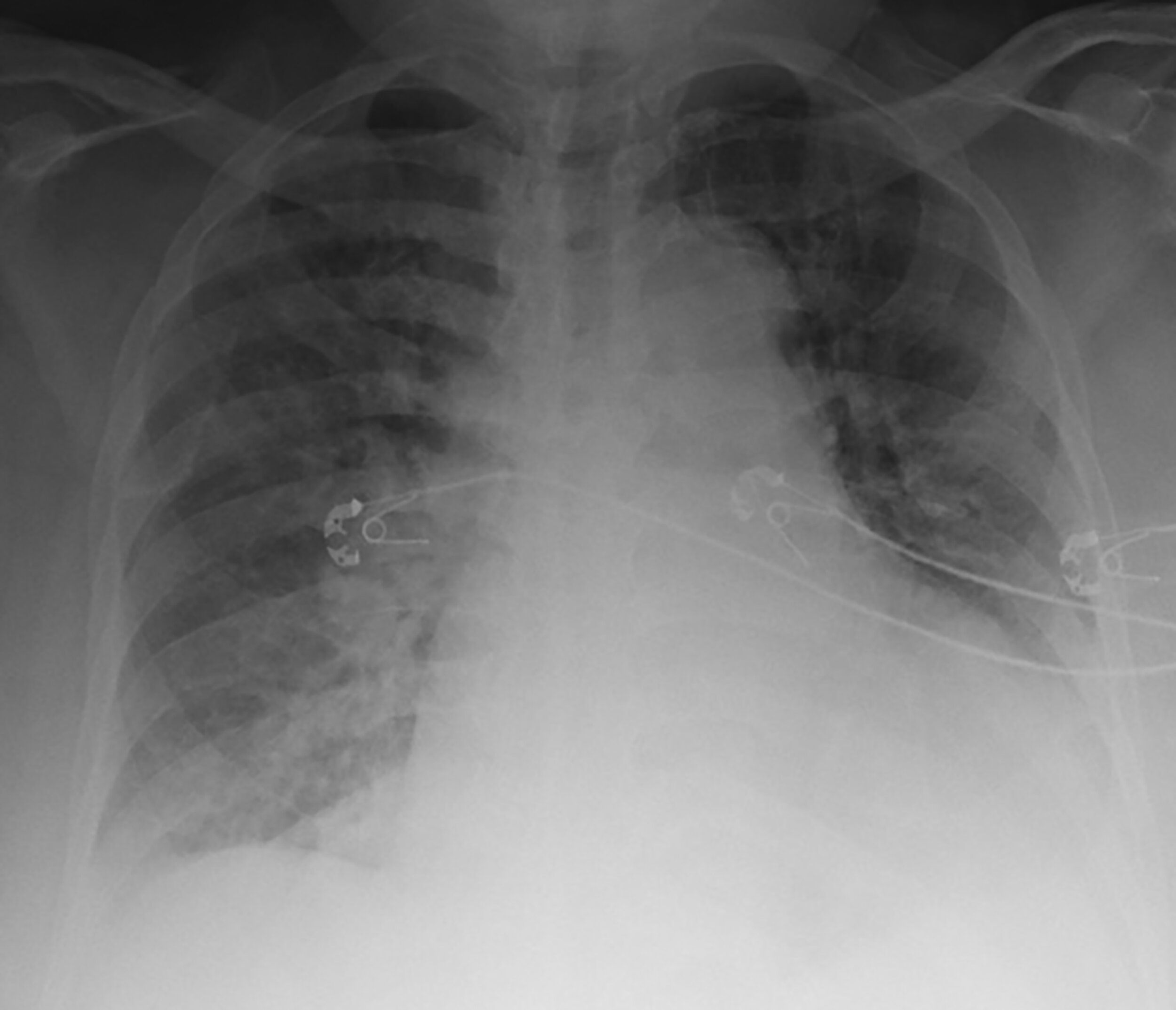 Chest X Ray With Heart Failure
