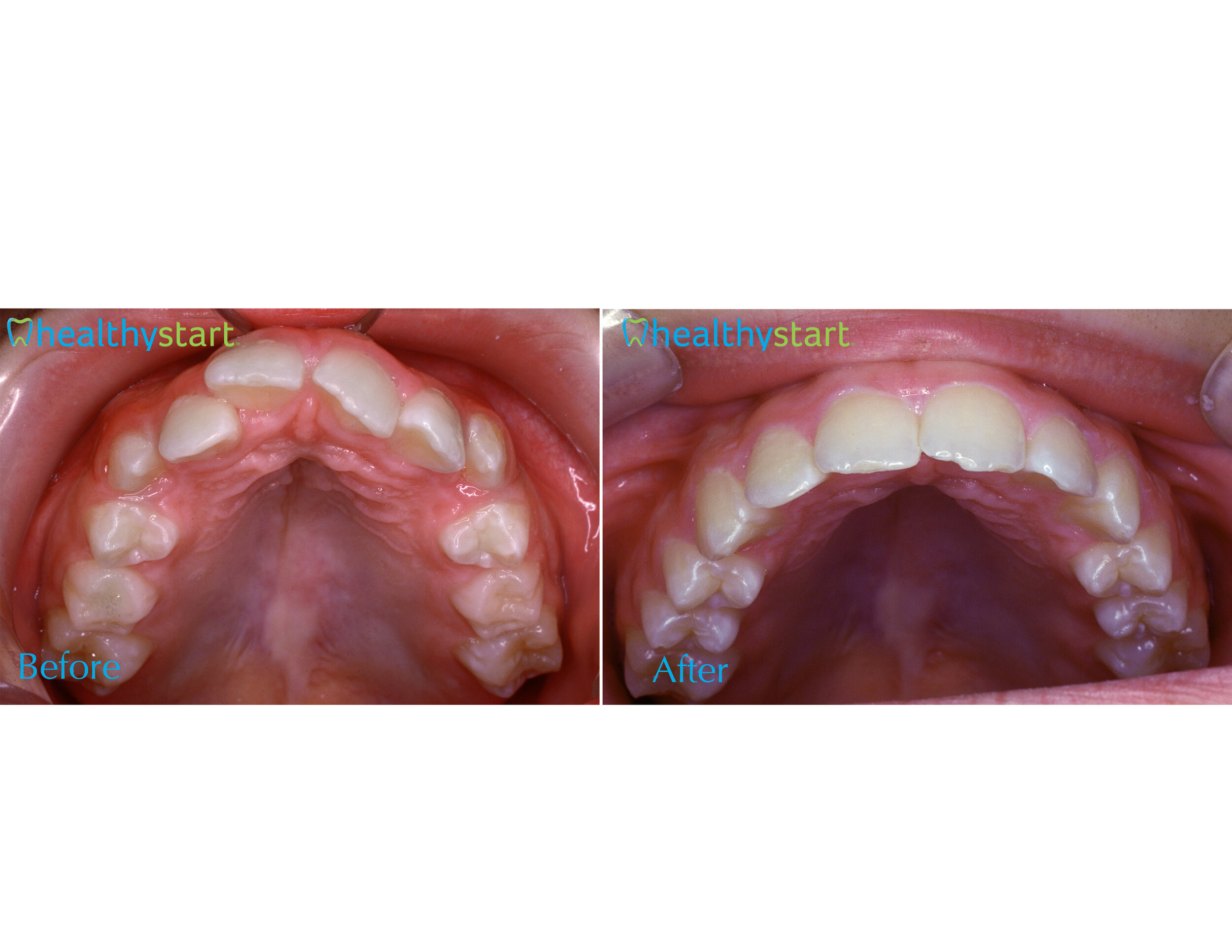 Upper Arch Crowding Before &amp; After