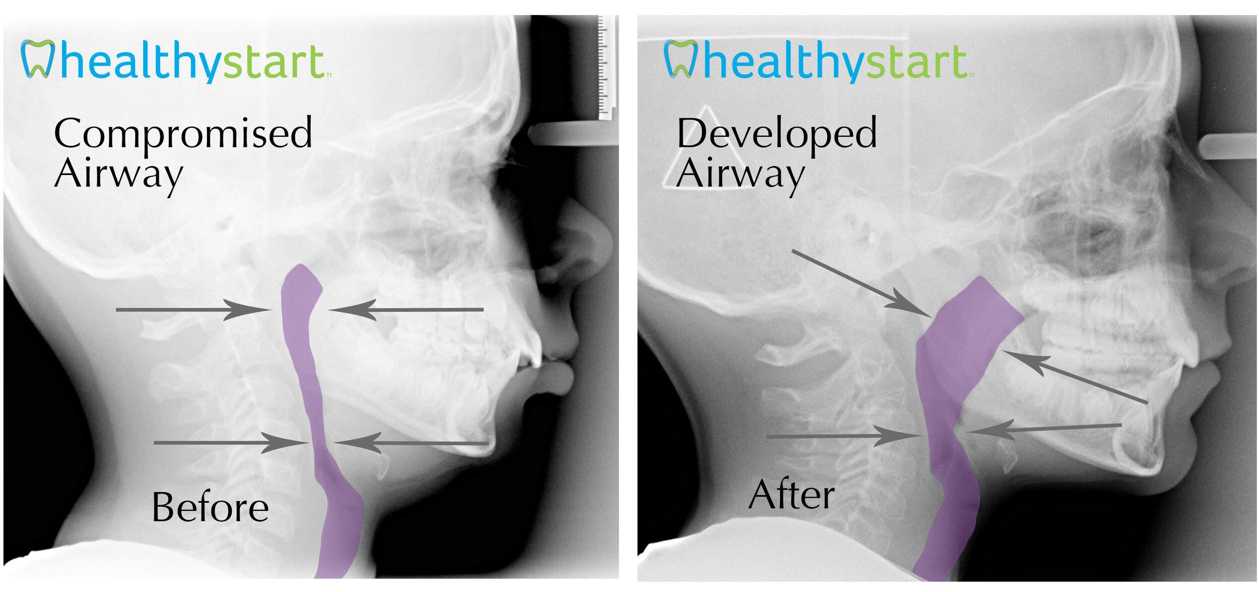 Compromised and Developed Airway.jpg