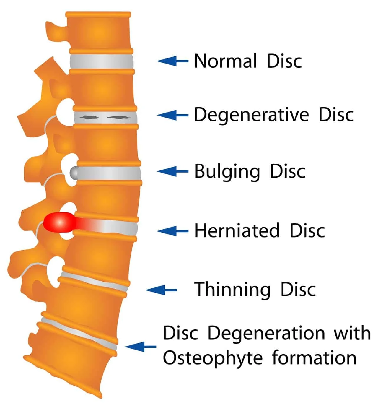 Disc Degeneration.jpg