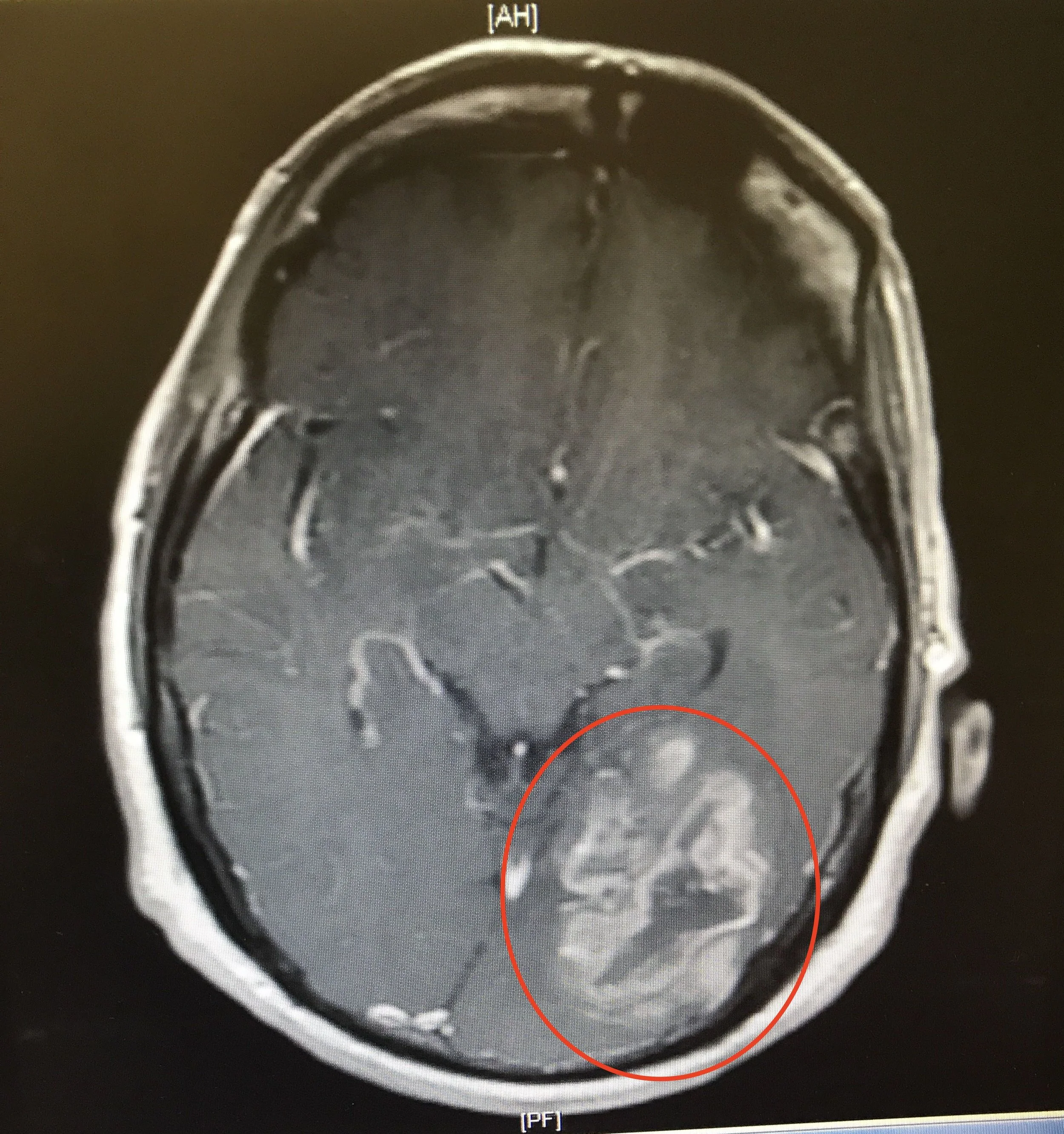 Left PTO grade III glioma