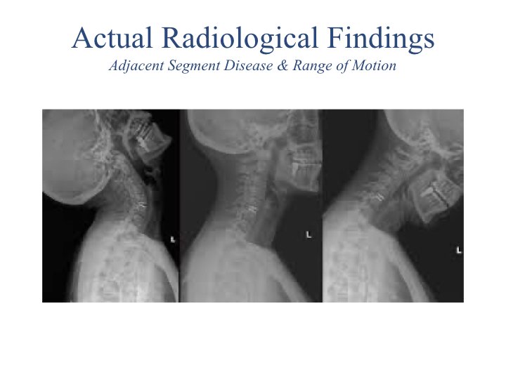 Motion Preserving Spine Surgery.032.jpeg