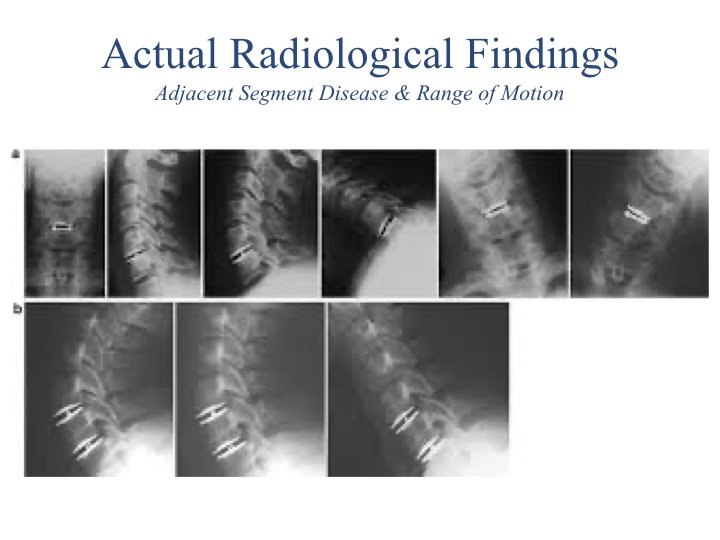 Motion Preserving Spine Surgery.033.jpeg