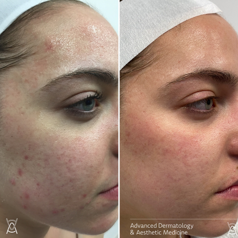 The Microneedling Rundown With Before and After Photos – Perfect Face  Aesthetic Medicine
