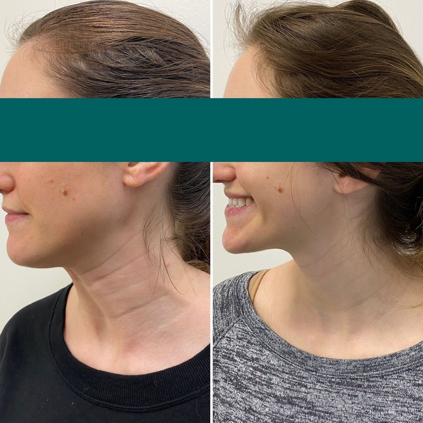 An advanced technique to treat those horizontal lines in your neck: neck botox⁣
- reduces neck wrinkles ⁣
- relaxes the downward pull of your neck muscles ⁣
- minimizes (very early) Jowls⁣
- improves the jawline⁣
⁣
For a consultation with Dr. Rani, p