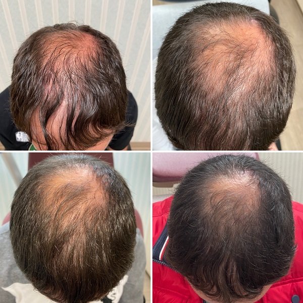 PRP For Hair Loss Before And After Images- Advanced Dermatology & Aesthetic Medicine (1).JPG