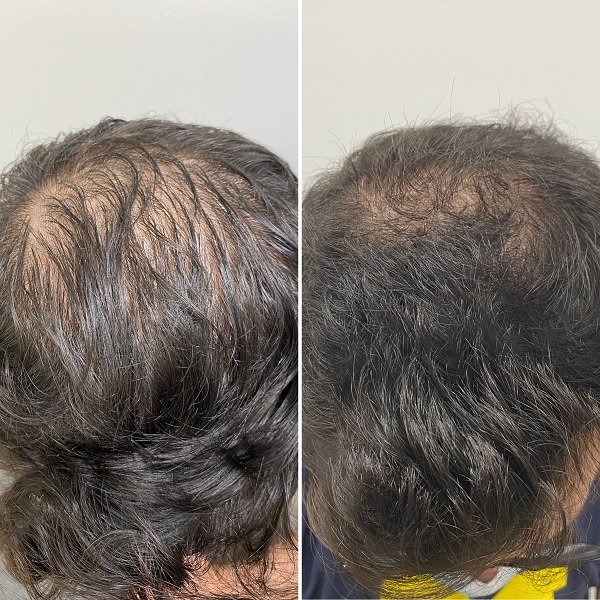 PRP For Hair Loss Before And After Images- Advanced Dermatology & Aesthetic Medicine (8).JPG