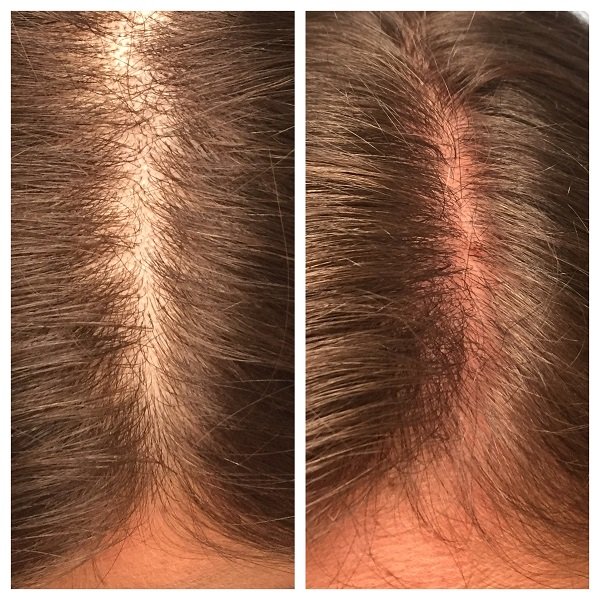 PRP For Hair Loss Before And After Images- Advanced Dermatology & Aesthetic Medicine (7).JPG