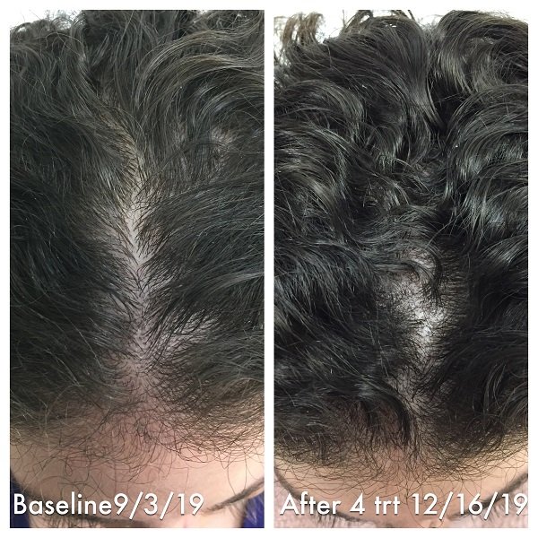 PRP For Hair Loss Before And After Images- Advanced Dermatology & Aesthetic Medicine (6).JPG