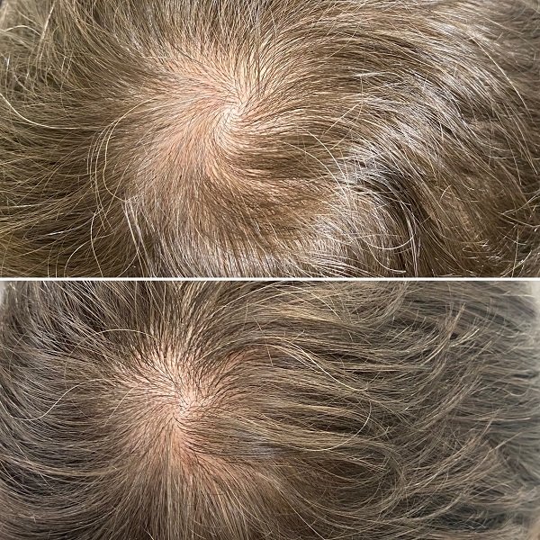 PRP For Hair Loss Before And After Images- Advanced Dermatology & Aesthetic Medicine (5).JPG