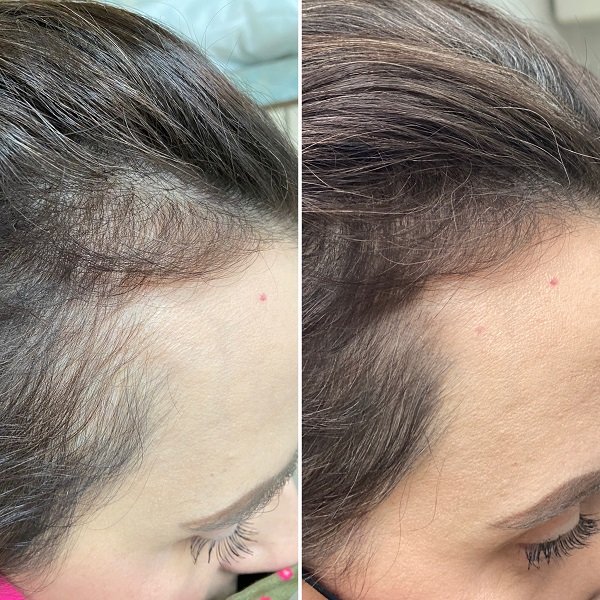 PRP For Hair Loss Before And After Images- Advanced Dermatology & Aesthetic Medicine (4).JPG