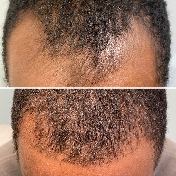 PRP For Hair Loss Before And After Images- Advanced Dermatology & Aesthetic Medicine (2).JPG