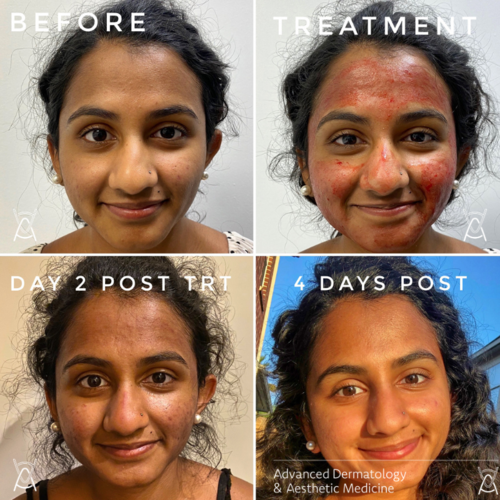 Microneedling-patient-4.png