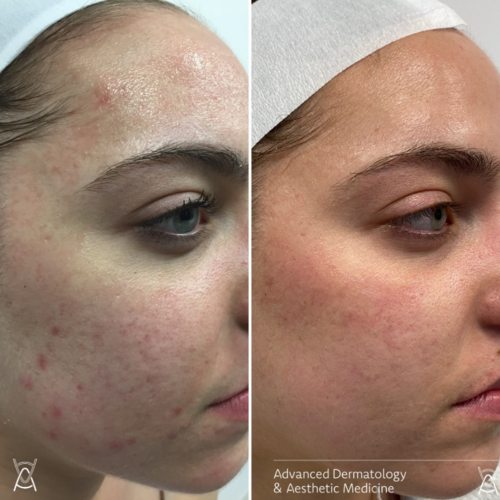 Microneedling-patient-2.png