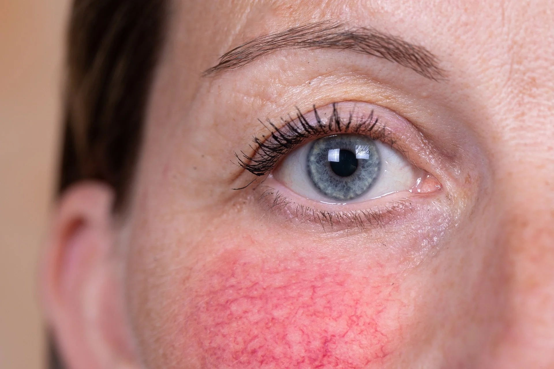Does Laser Treatment Work For Rosacea?