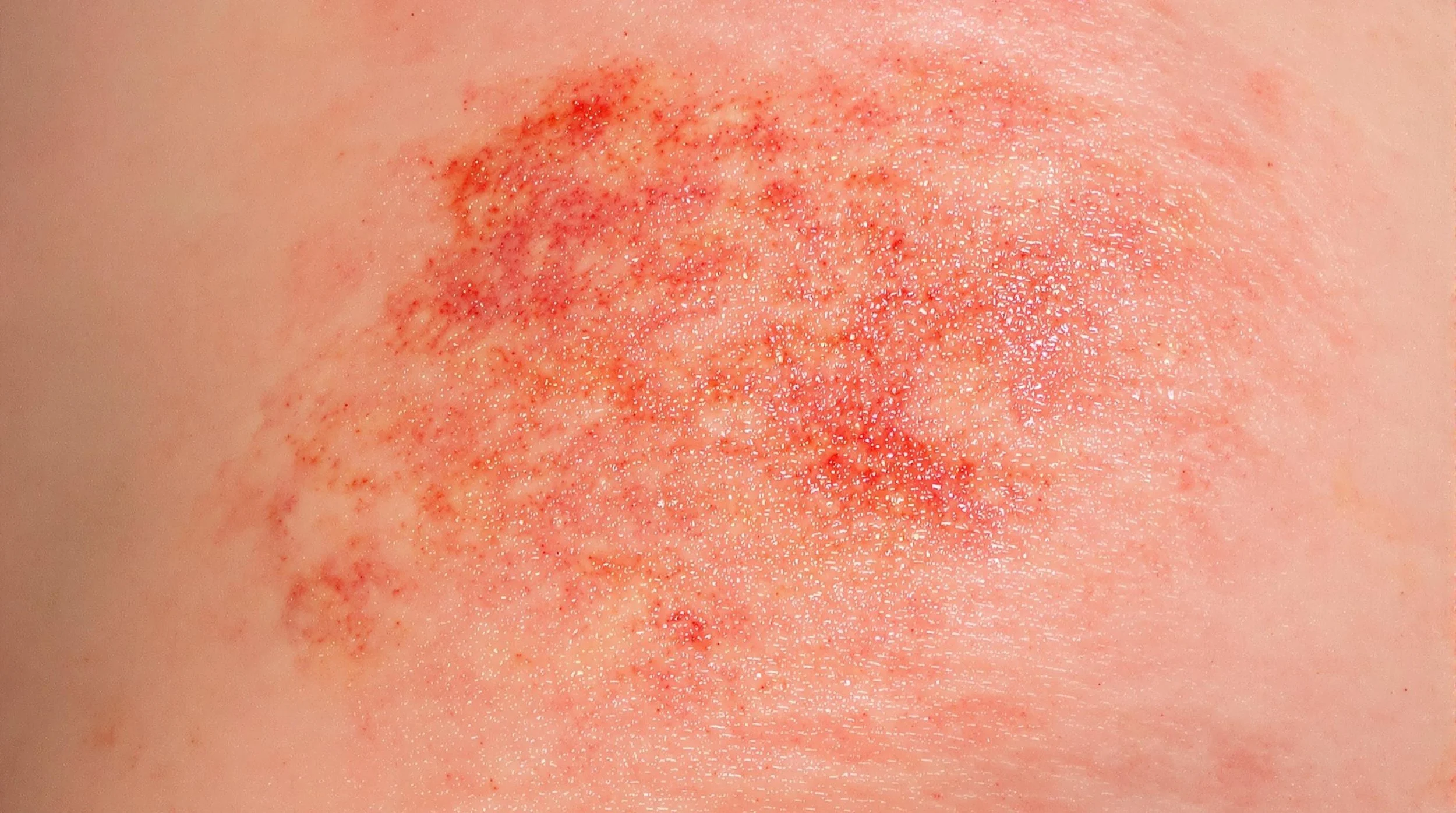 Chlorine Damage to Skin: Understanding, Preventing, and Treating Pool-Related Skin Problems