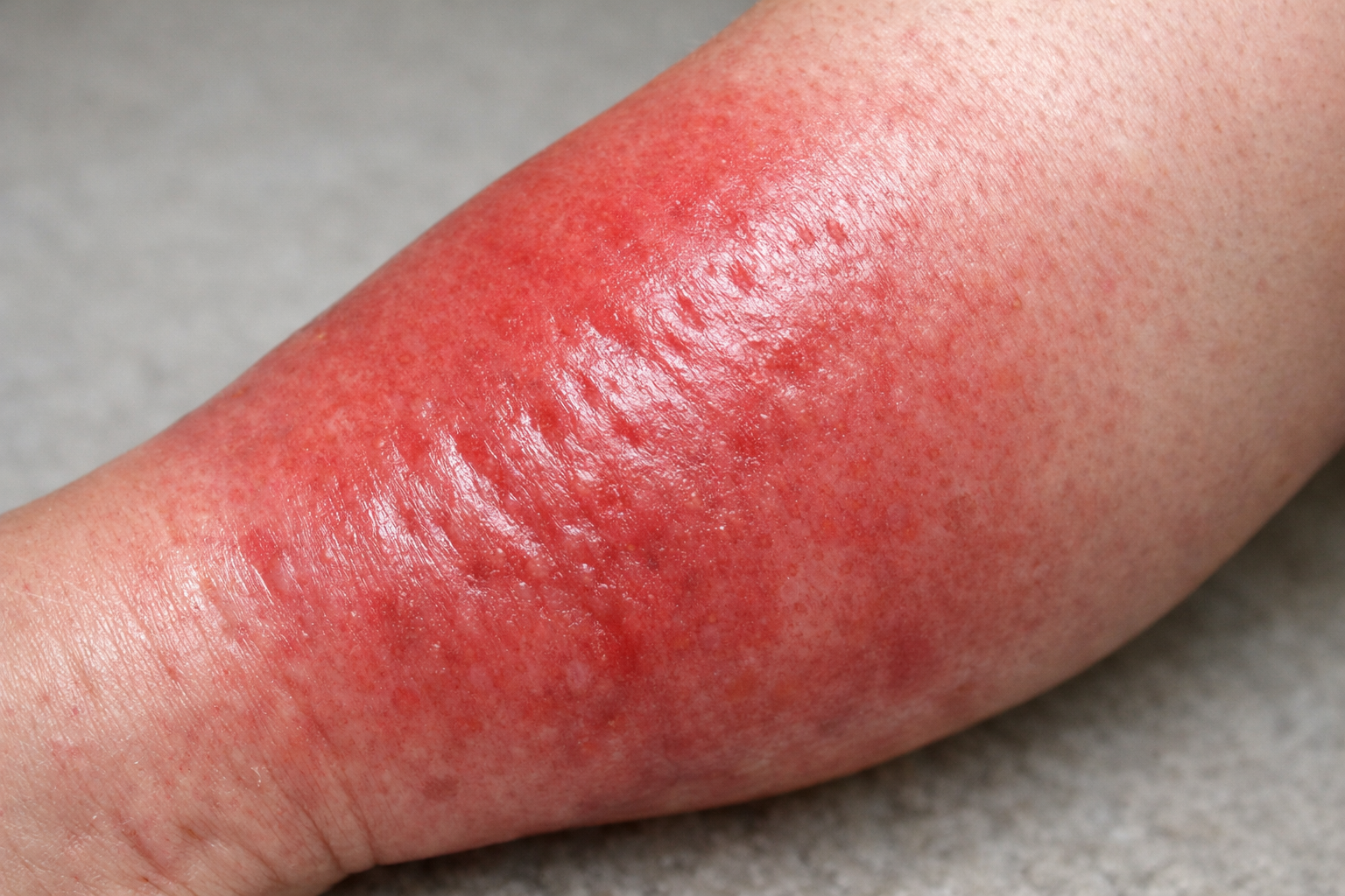 Cellulitis Specialists Chicago: Expert Treatment &amp; Care | Advanced Derm