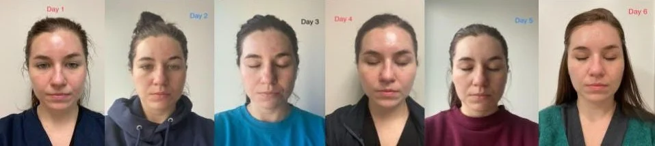 Before and after chemical peel results showing improved skin texture and tone in Chicago patient