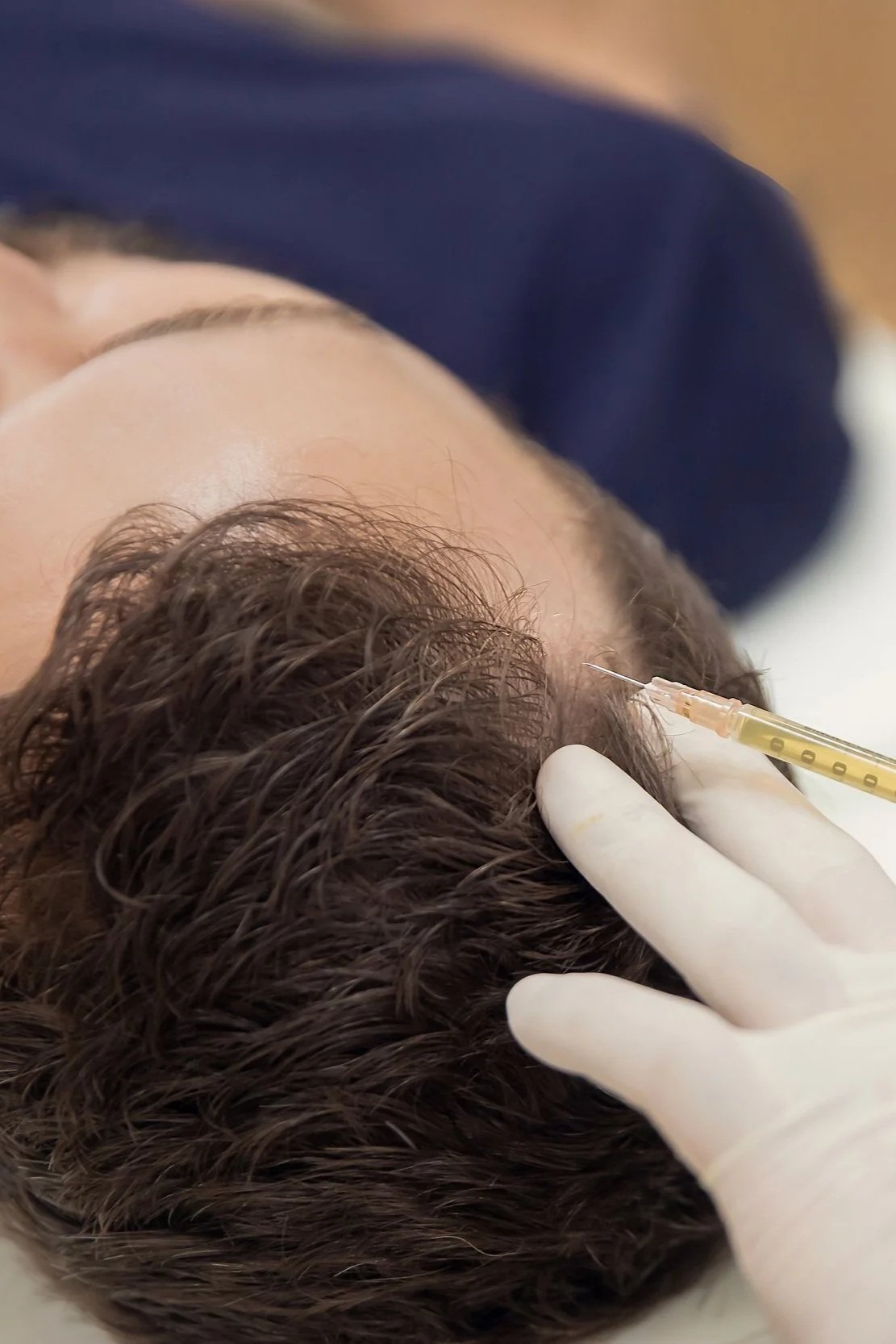 PRP for Hair Loss (4-pack)