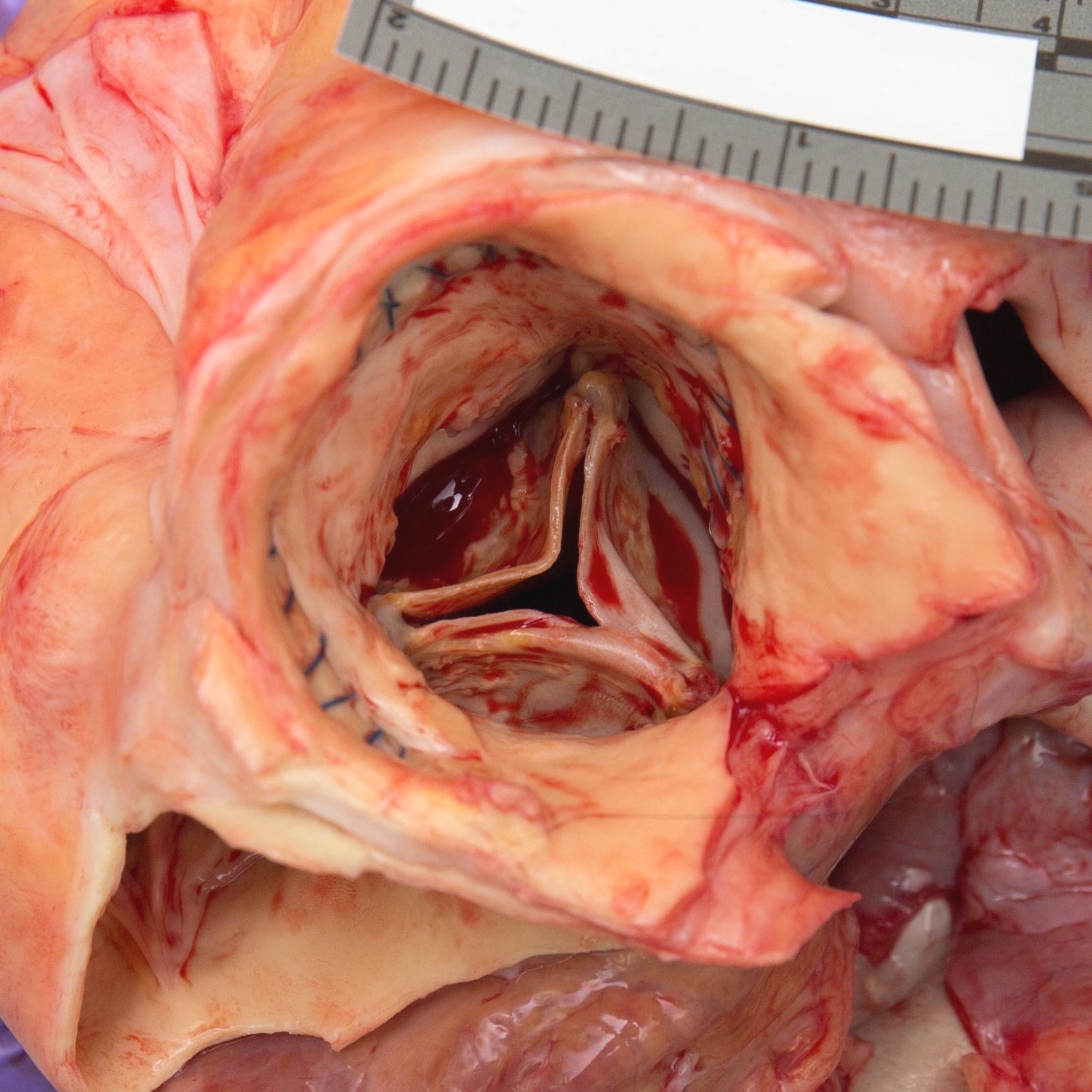 Heart: tricuspid valve
