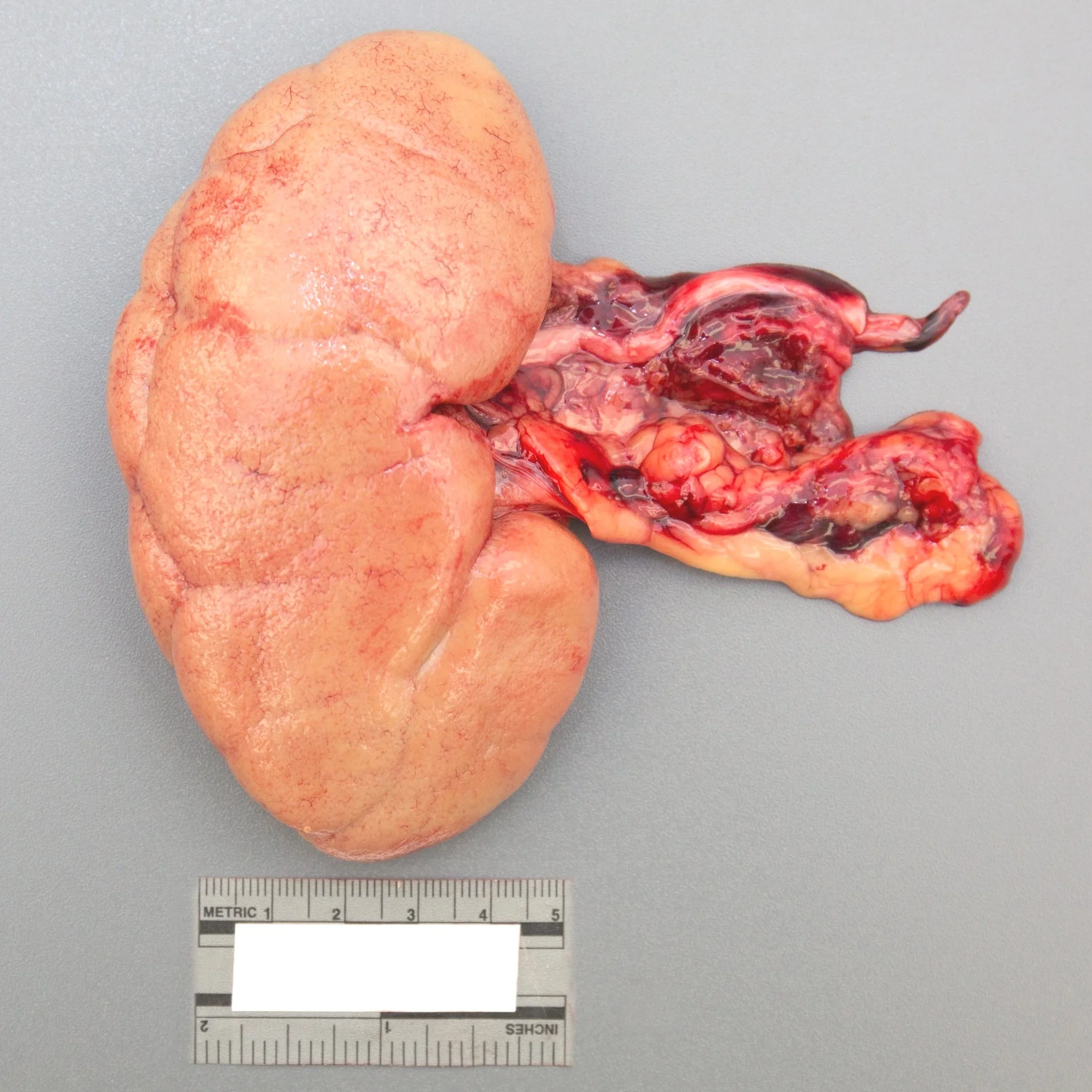 Kidney: Pale, diffuse exsanguination