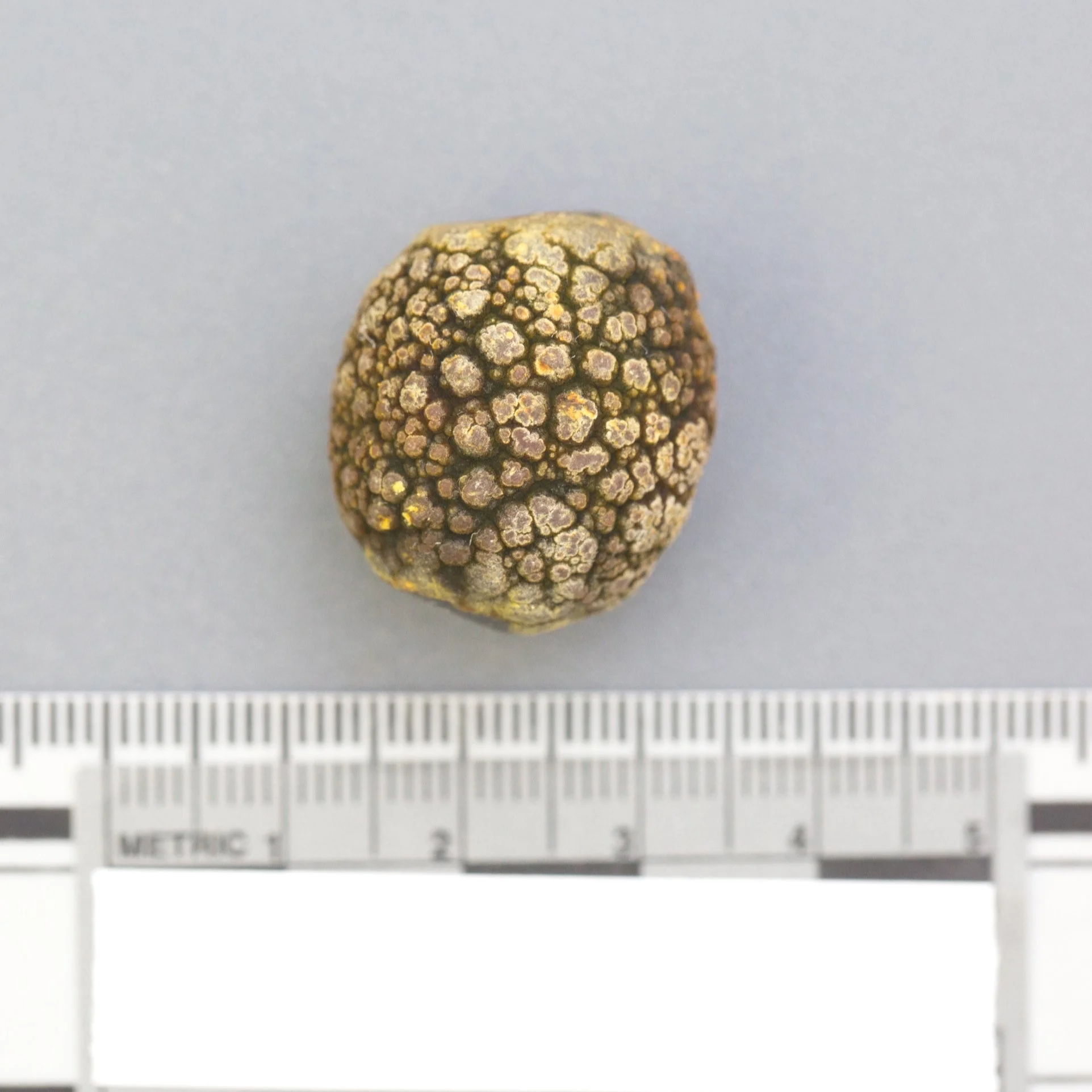 kidney stone