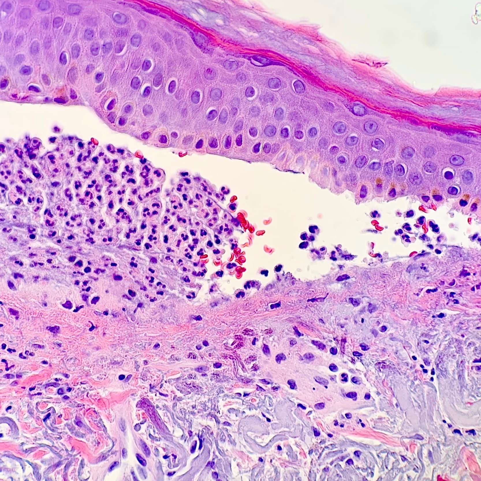 Dermo-Epidermis Junction: necrosis