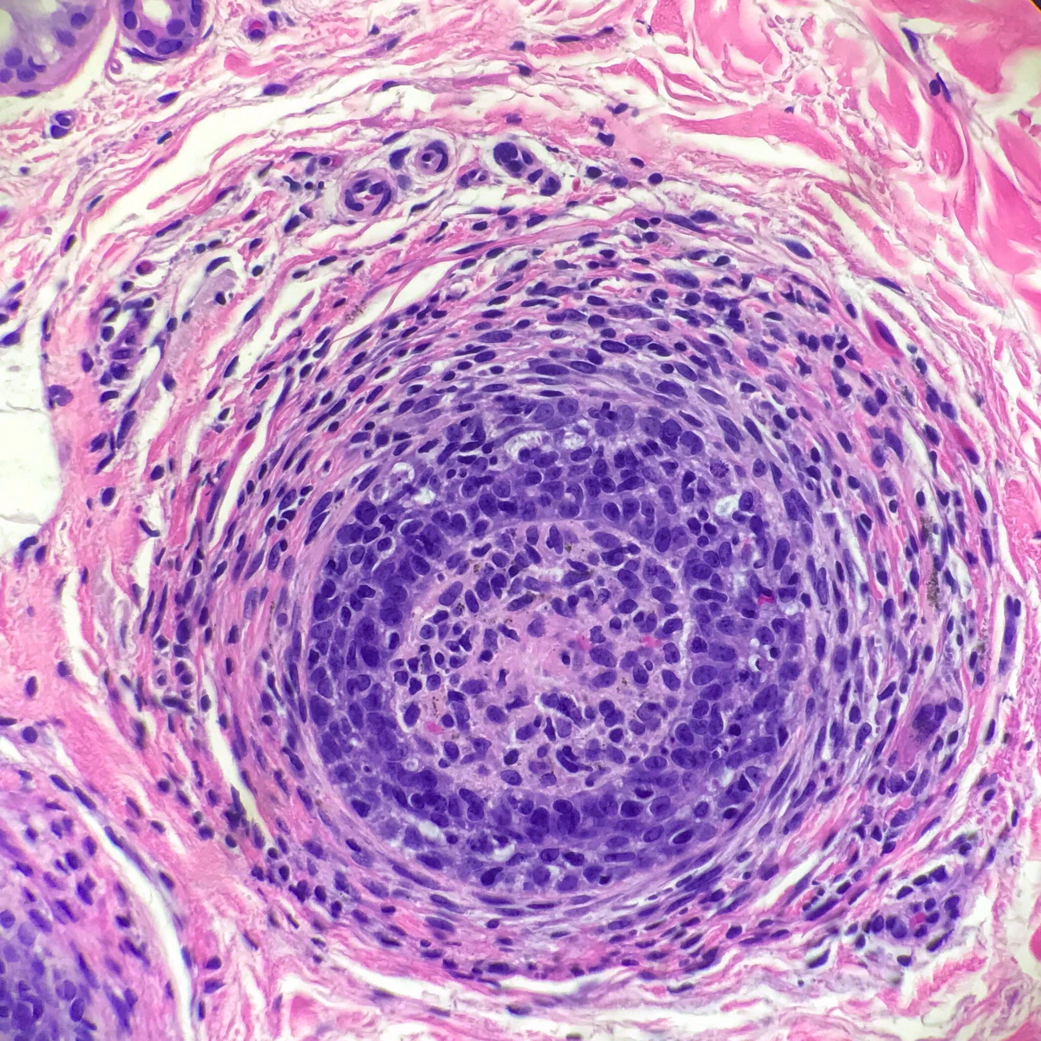 Dermis: ‘Swarm Bees’