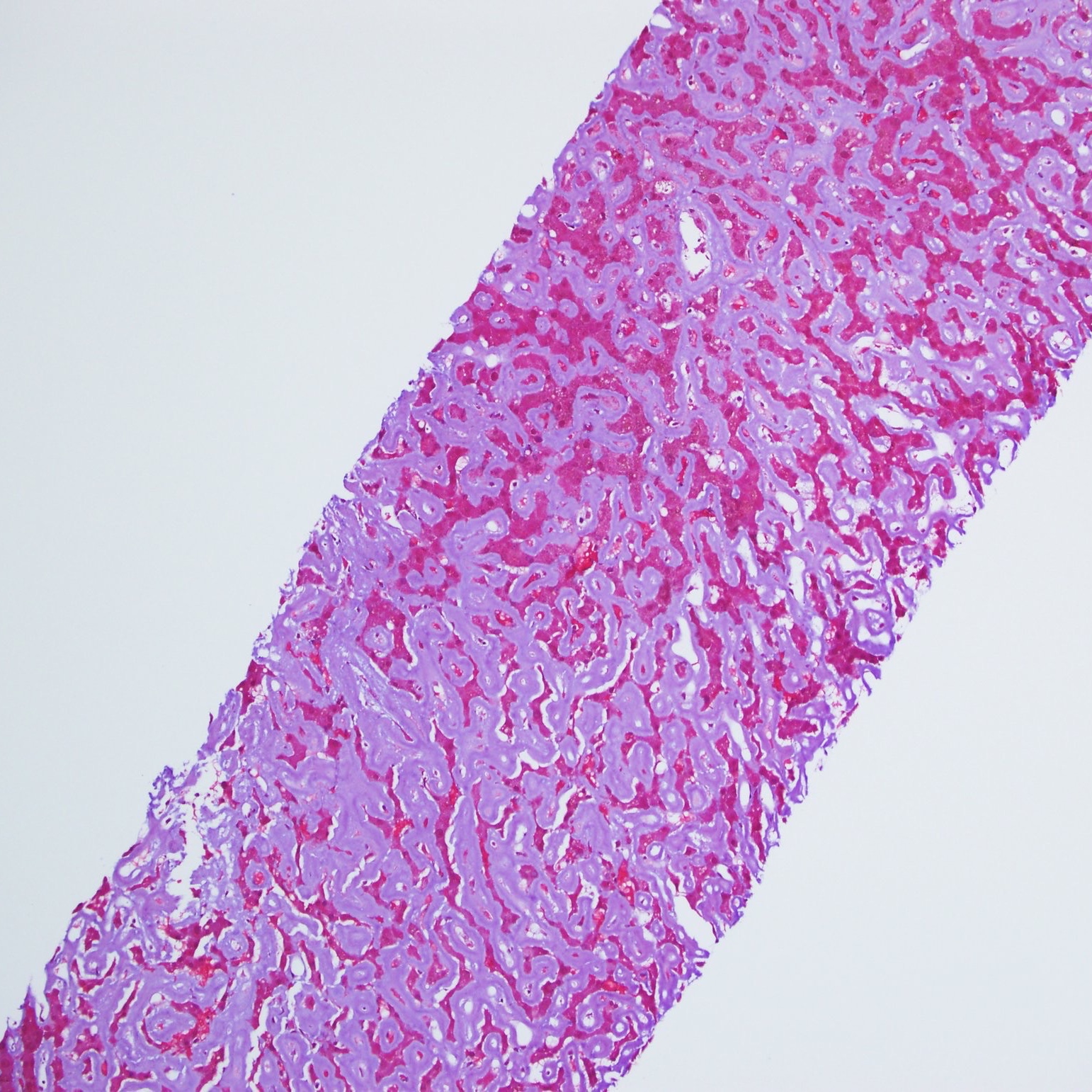 Liver Biopsy: Amyloid diffuse