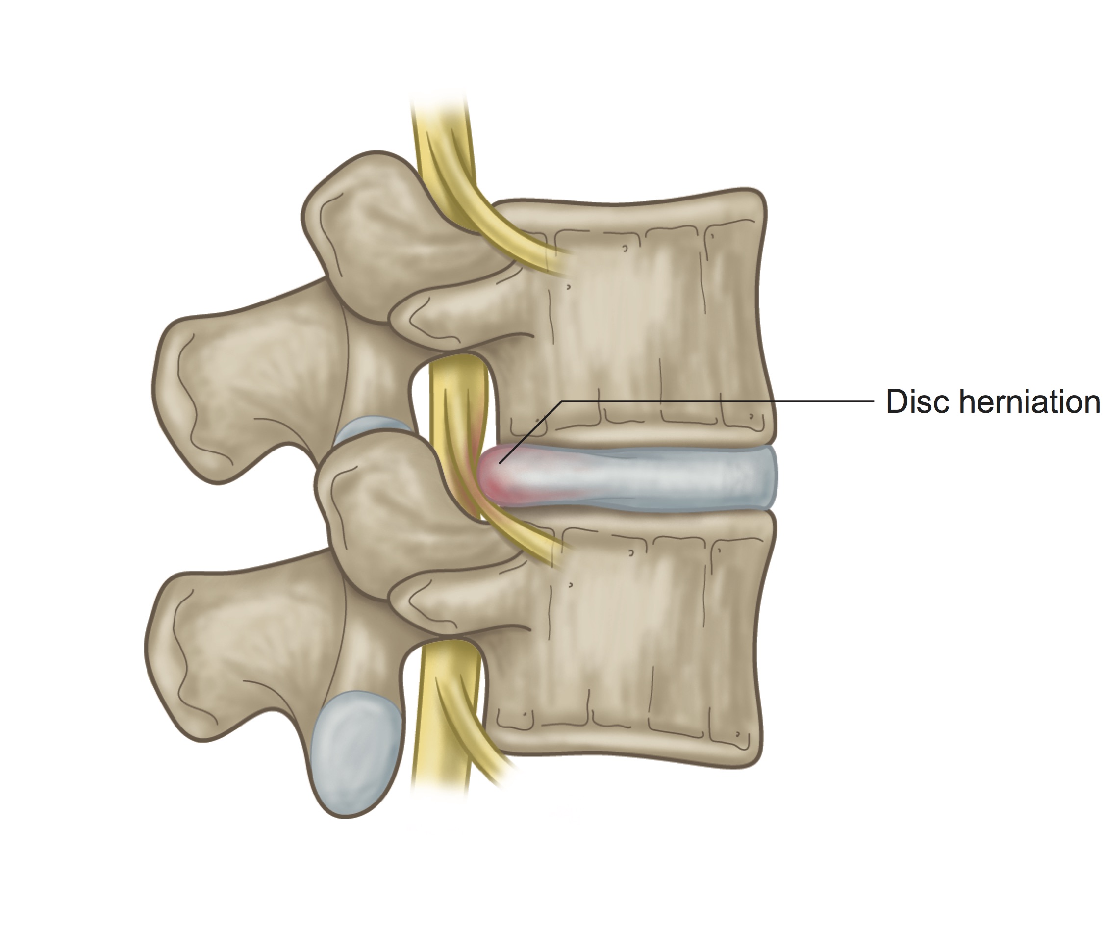 The Best Sleeping Position For Herniated Disc & Bulging Discs 