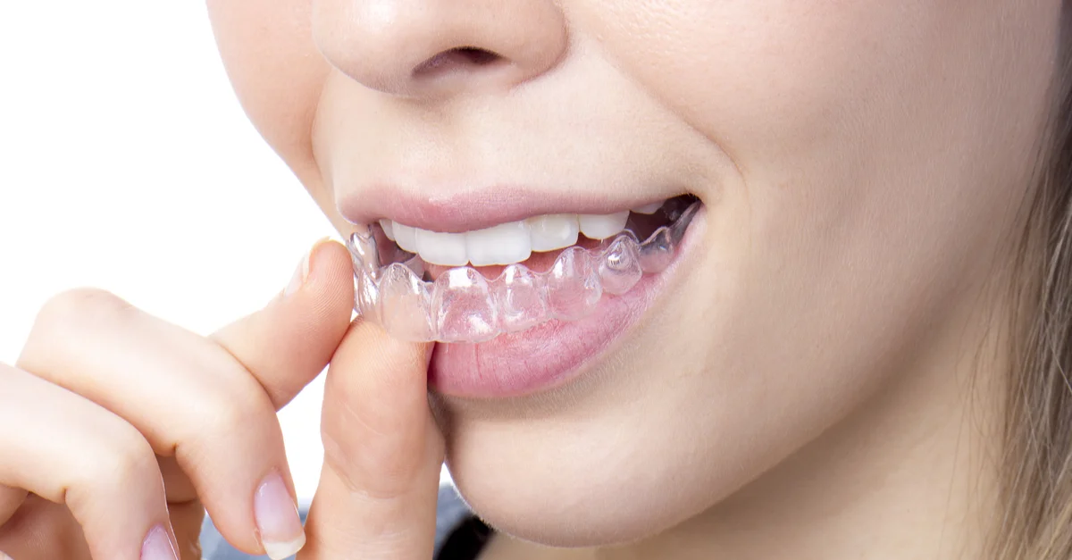 A Patient's Blog - Changing my Smile with Invisible Braces 