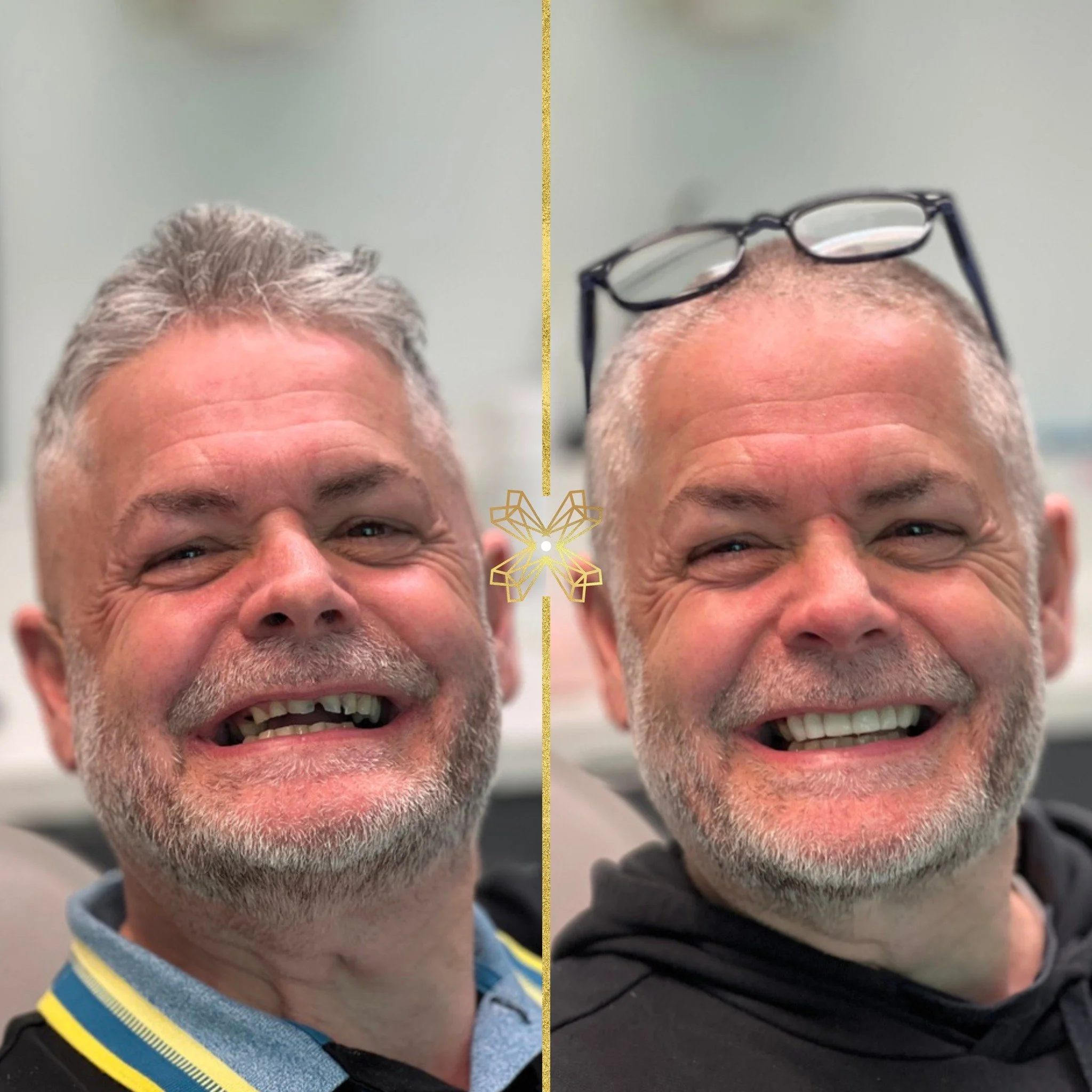Smile transformation! 🤩

Dr Barnes working his magic with composite bonding! ✨

If a smile makeover is what you're after, call us on 01253 736633 or DM us today 😁🦷

 #dentistry #dentist #smile #smilemakeover #compositebonding #lytham #lythamlife #