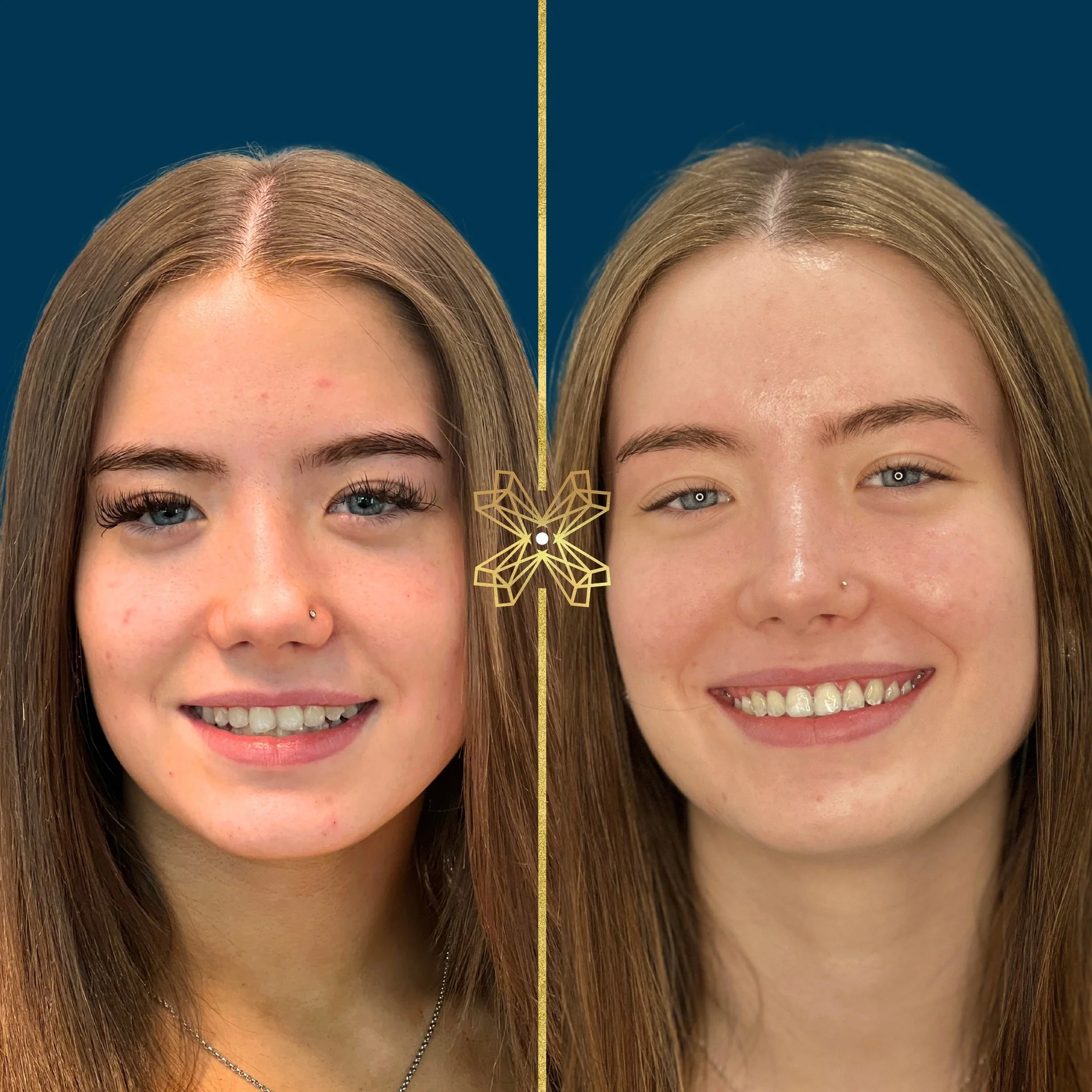 Before and after - Smile transformation! 🤩😁✨

Look at that difference! No more wonky teeth - just a beautifully aligned, natural-looking smile!

Curious about what Invisalign could do for you? Book your consultation today! 
Call 01253 736633 or DM 