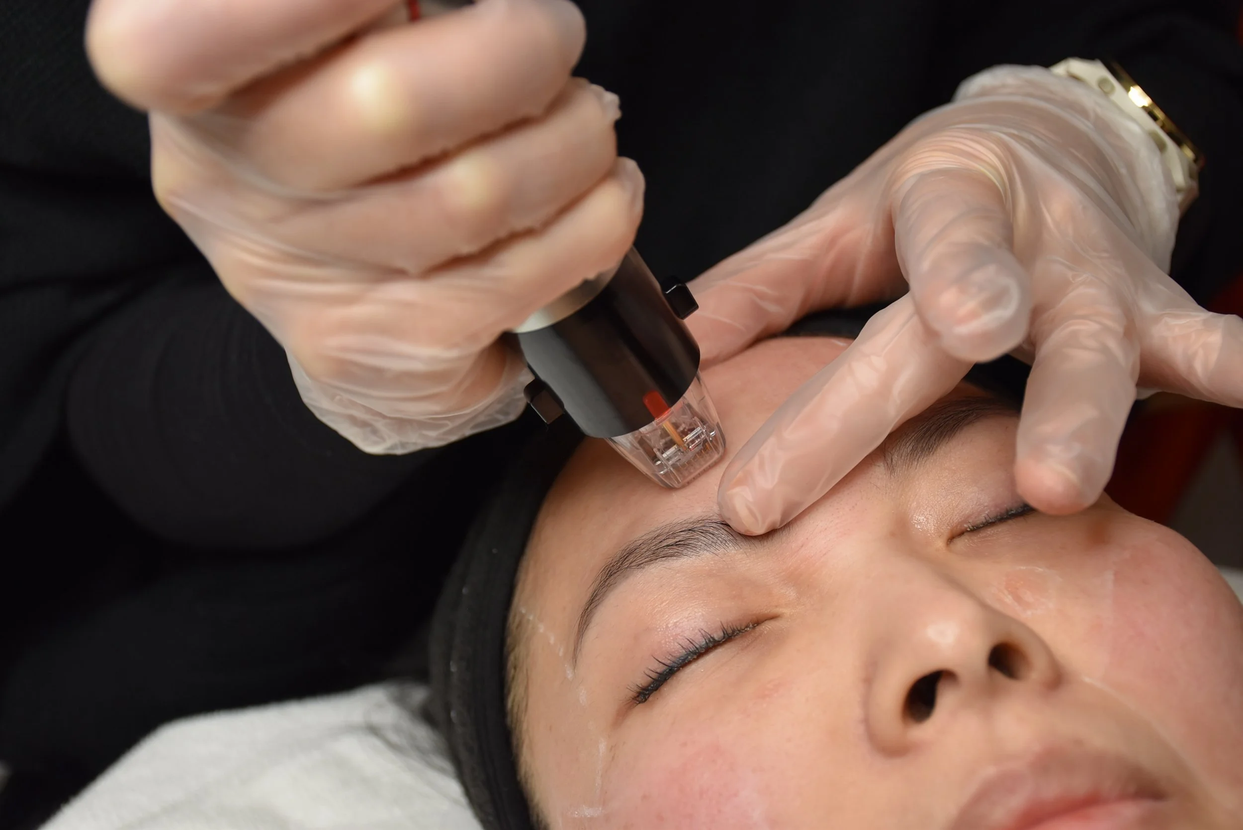 GENIUS RF MICRONEEDLING — La Belle Peau Skincare Clinic