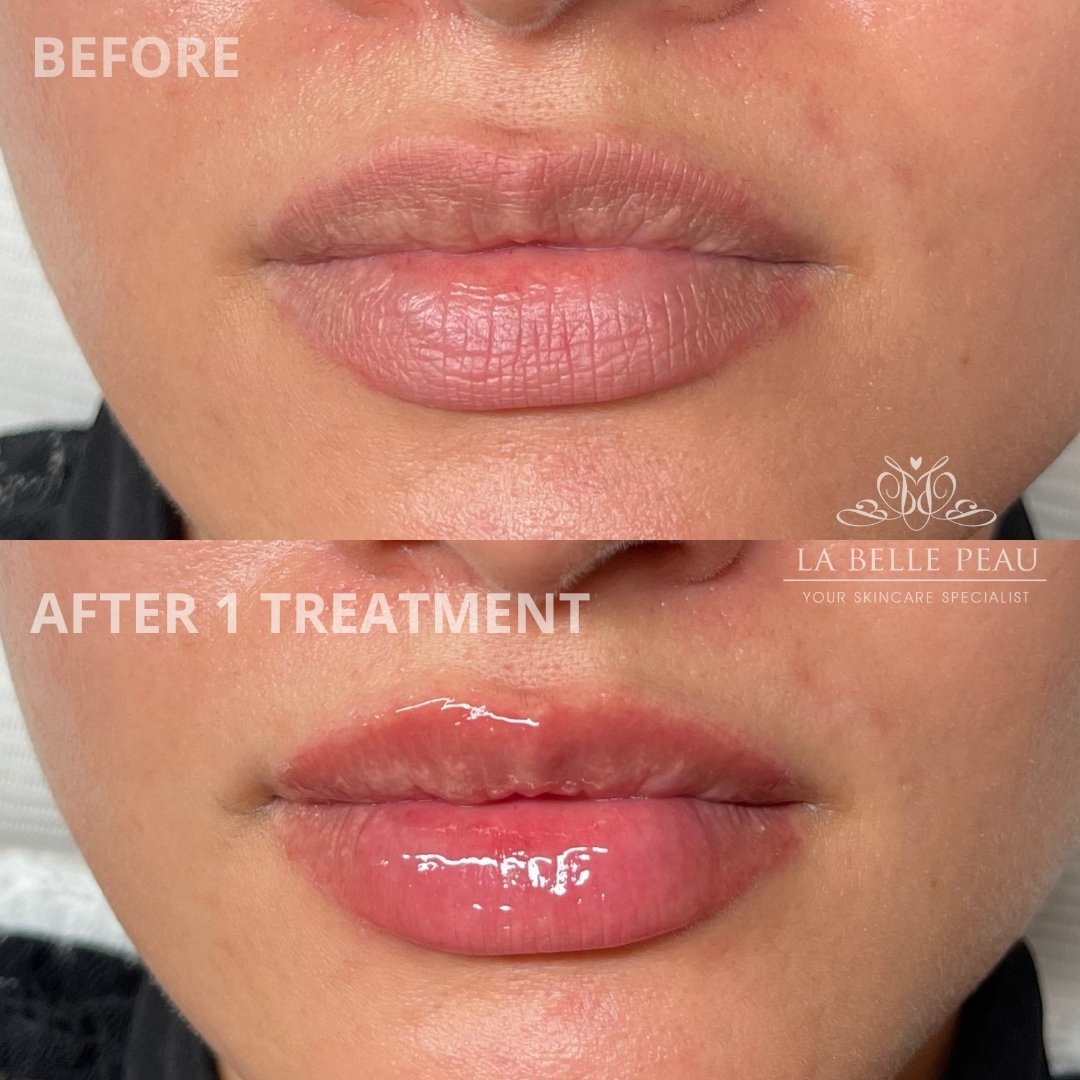 Loving our lip laser treatment! 😍

Try it today with our introductory offer - Receive your first session for only $75 💙 Normally $125.

Course of treatment is recommended for optimum results.

#labellepeauperth #labellepeau #skinbylbp #liplaser #li