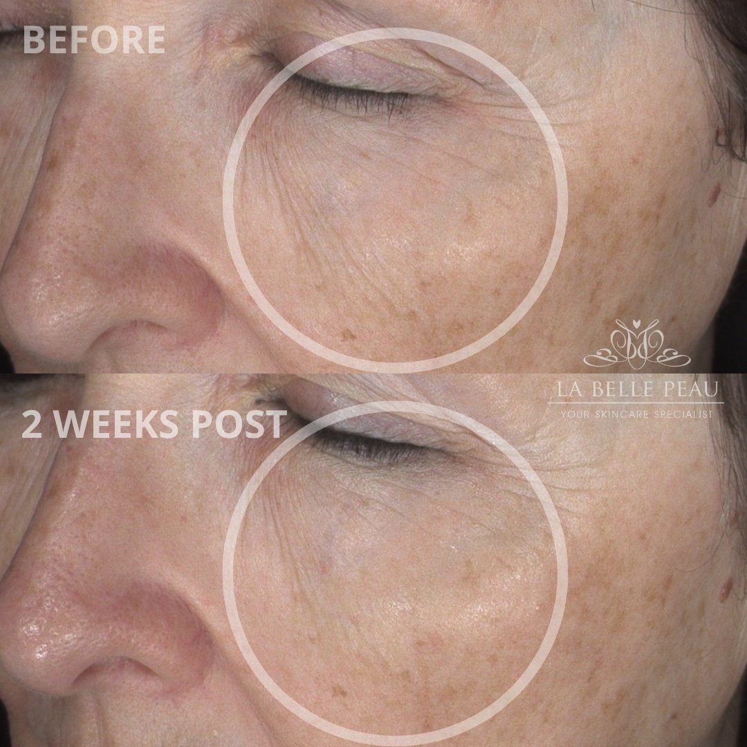 After just 2 weeks on personalised home care! 😍⠀⠀⠀⠀⠀⠀⠀⠀⠀
⠀⠀⠀⠀⠀⠀⠀⠀⠀
You can already see the start of improvement in the fine lines &amp; wrinkles, dehydration and skin tone &amp; texture. ⠀⠀⠀⠀⠀⠀⠀⠀⠀
⠀⠀⠀⠀⠀⠀⠀⠀⠀
For this client it was most important to h