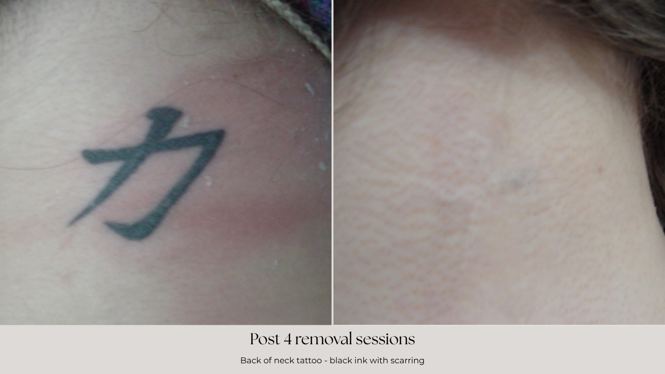 After 1 session (1).png