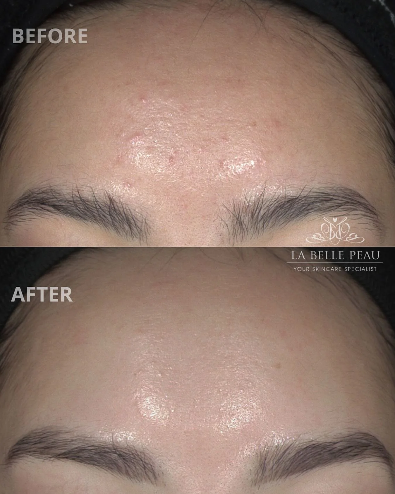 The right homecare routine can really make all the difference in just a few weeks 😍✨

Loving the glow with the improvement of texture &amp; the reduction in breakouts!

#labellepeau #skinbeforeandafter #skinbylbp #skinclinicperth #ultraceuticals #as