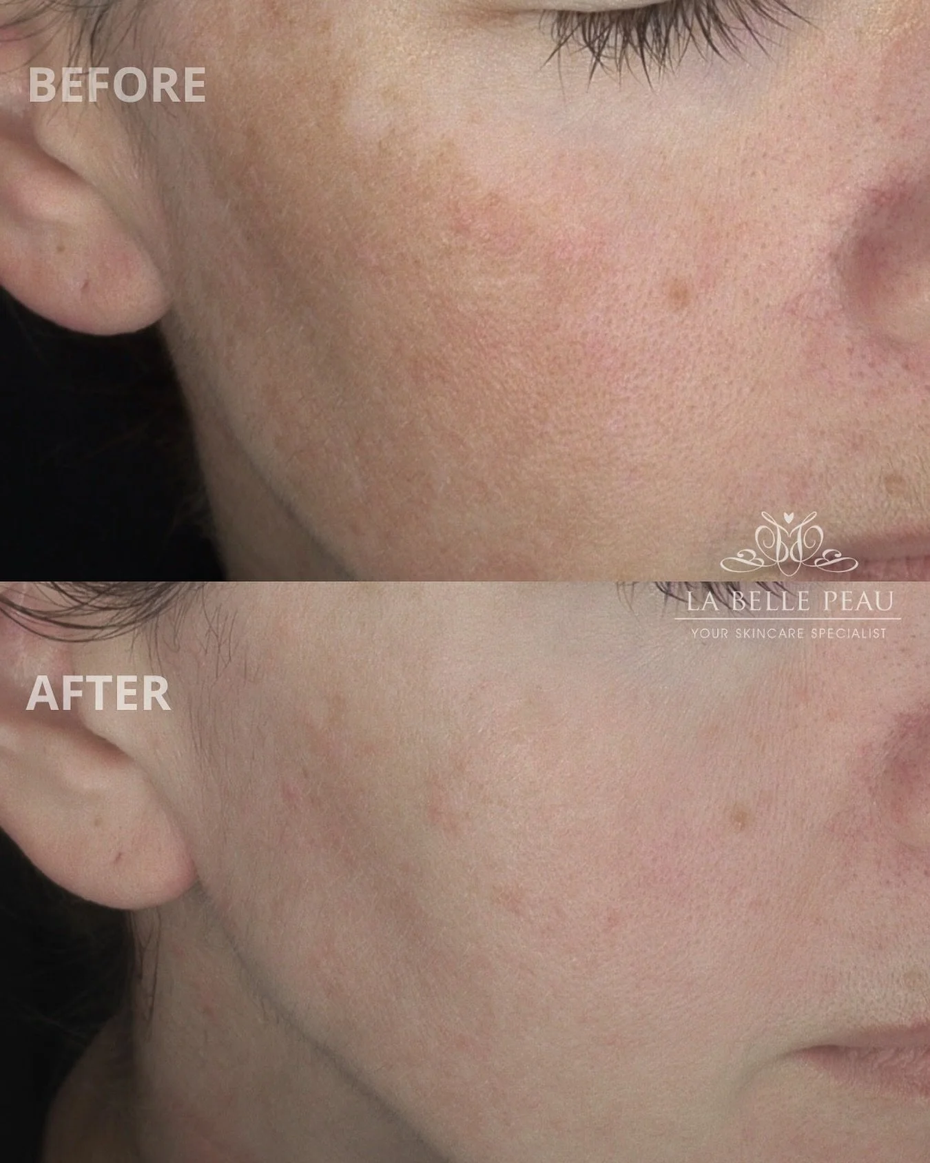 We love when a personalised plan really comes together 🤝
⠀⠀⠀⠀⠀⠀⠀⠀⠀
At La Belle Peau we always emphasize the importance of a thorough skin consultation to ensure our recommendations are catered to you and we can achieve the results you are after! 🌸
