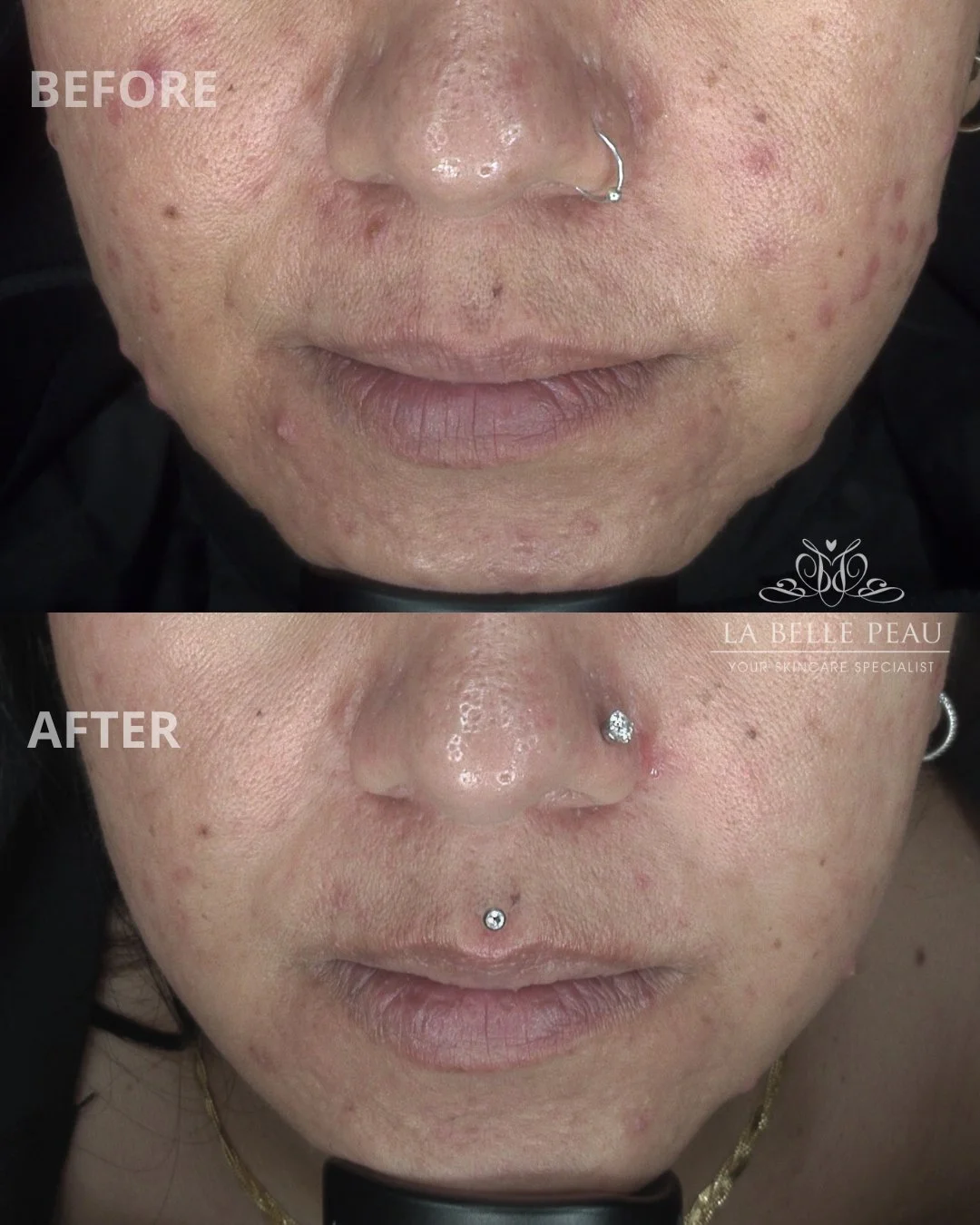 If you&rsquo;re struggling with acne, texture, scarring - this is your sign to not give up 💙

As part of this clients treatment plan, @xytide.bio Exosomes were added via precision skin needling to improve the skin barrier integrity that helps with f