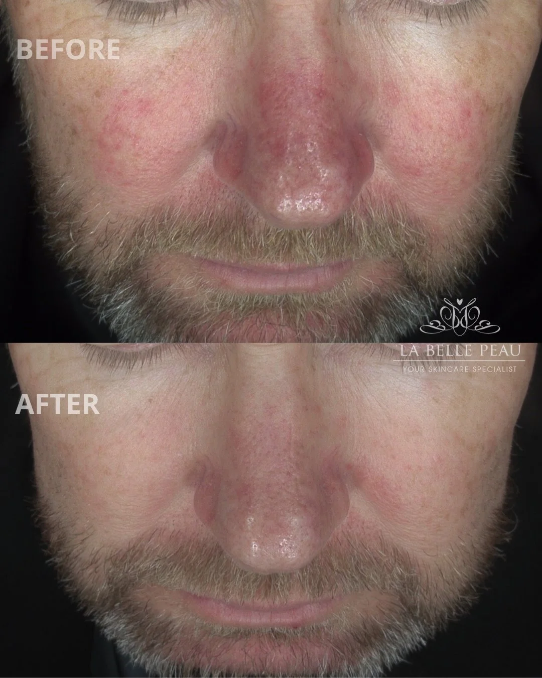 Visible rosacea improvement thanks to the power of exosomes! ✨

Exosomes are amazing, stem cell-derived nano-vesicles that provide a gentle, non-invasive treatment for rosacea. In this client&rsquo;s case, they helped reduce chronic inflammation and 