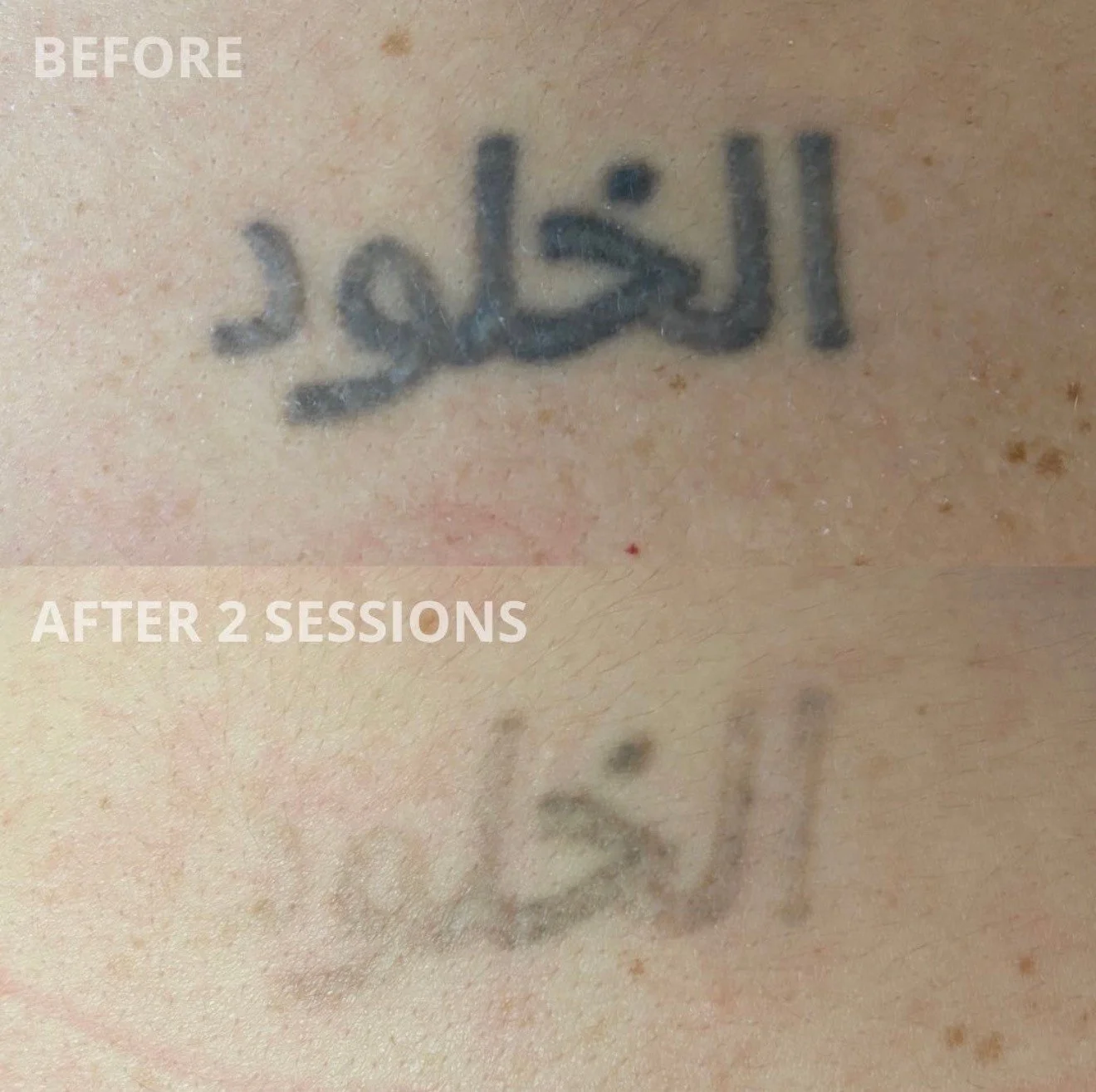 LASER TATTOO REMOVAL ⚡️

Ready to remove a tattoo? Enjoy free consultation and 50% off your first session. 

At La Belle Peau, we prioritize your safety and satisfaction. Our state-of-the-art Lutronic Hollywood Spectra Laser is the world&rsquo;s lead