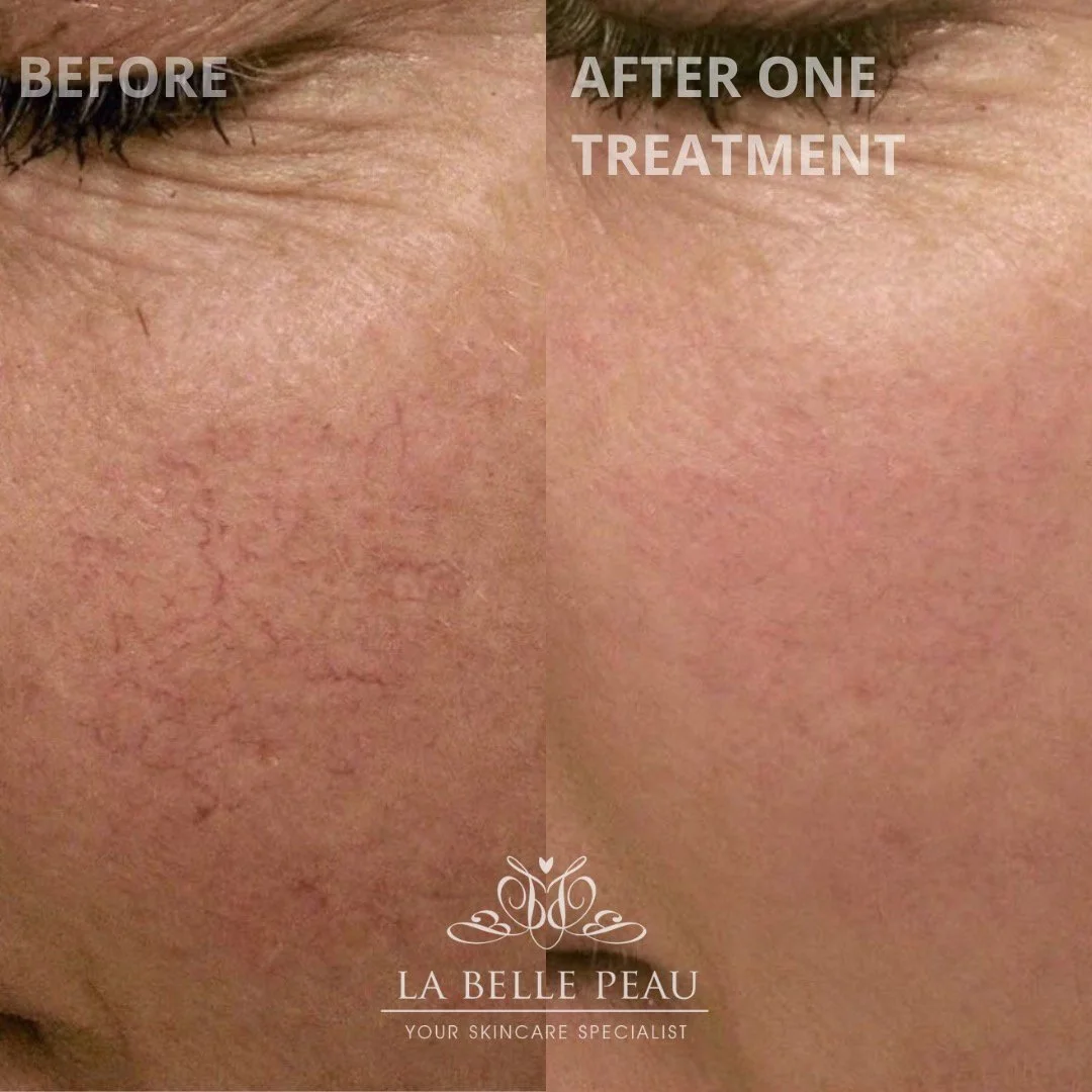 🌟 Goodbye Red Veins, Hello Healthy Skin!🌟 

Say farewell to those pesky red veins and embrace a brighter, more confident you! Our Clinical Skin Clear treatment harnesses the power of high and radio frequencies to safely and effectively remove facia
