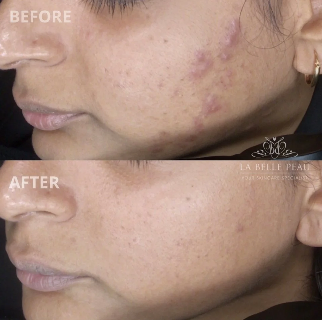 She put in the work, and it truly paid off! 😍​​​​​​​​
​​​​​​​​
This client came to us feeling deflated about her skin, unsure of the next steps. We began her journey with a comprehensive Observ Skin Analysis to develop a customized home care regimen