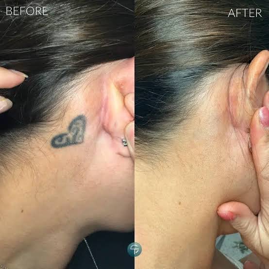 Laser Tattoo Removal Price in Perth: A Clinical Guide to Your Investment