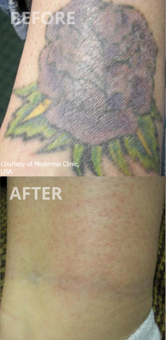 Tattoo Removal Perth — La Belle Peau Skincare Clinic