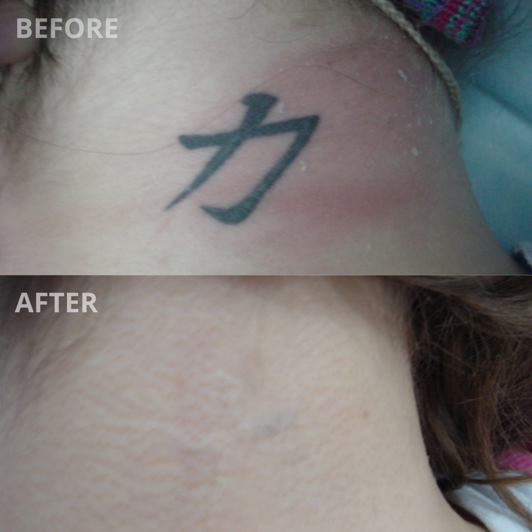 My Laser Tattoo Removal Journey - SKYN